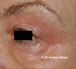 Madonna Lift Eye lid treatment with laser